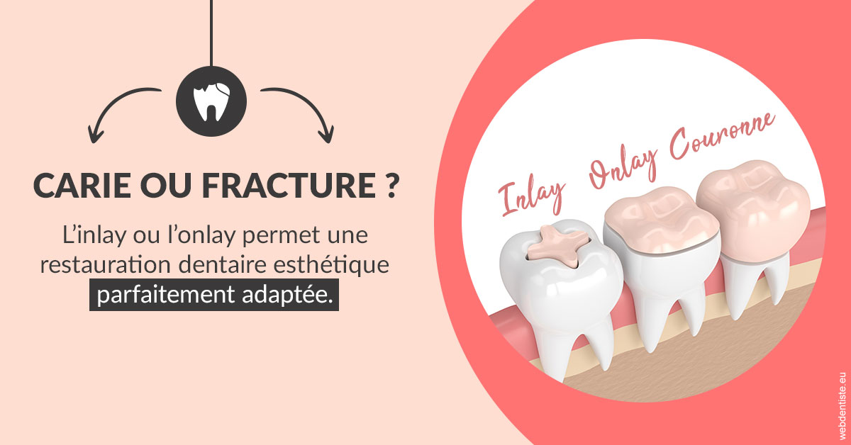 https://scp-des-docteurs-ollu-et-renaud.chirurgiens-dentistes.fr/T2 2023 - Carie ou fracture 2