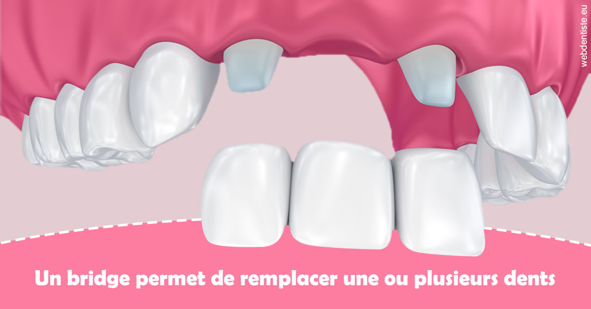https://scp-des-docteurs-ollu-et-renaud.chirurgiens-dentistes.fr/Bridge remplacer dents 2