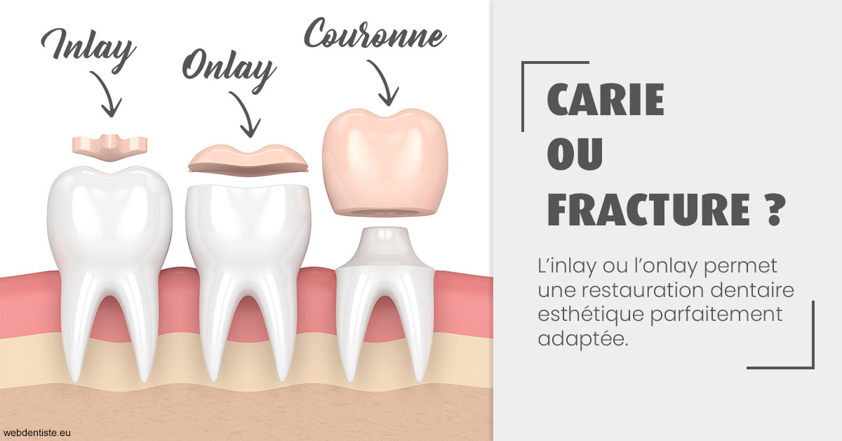 https://scp-des-docteurs-ollu-et-renaud.chirurgiens-dentistes.fr/T2 2023 - Carie ou fracture 1