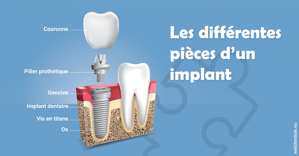 https://scp-des-docteurs-ollu-et-renaud.chirurgiens-dentistes.fr/Les différentes pièces d’un implant 1